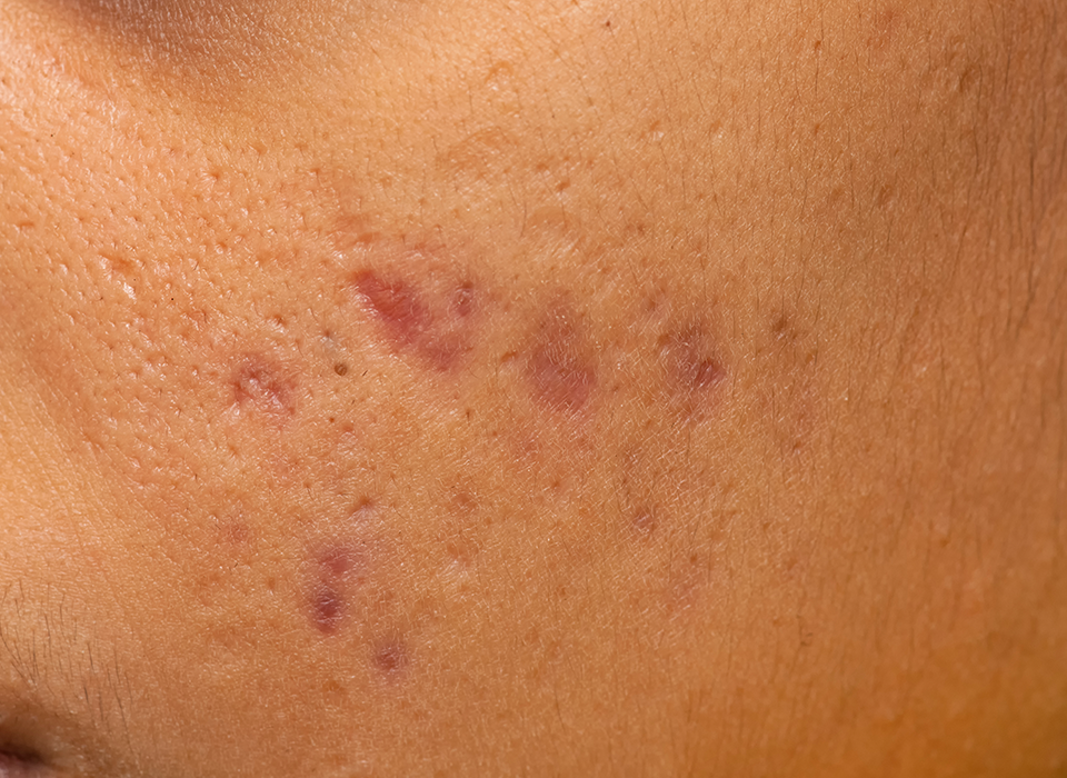 흉터 시그니처 ORACLE Signature