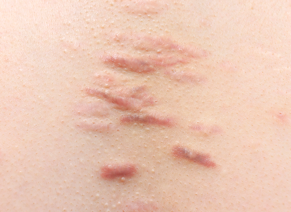 흉터 시그니처 ORACLE Signature