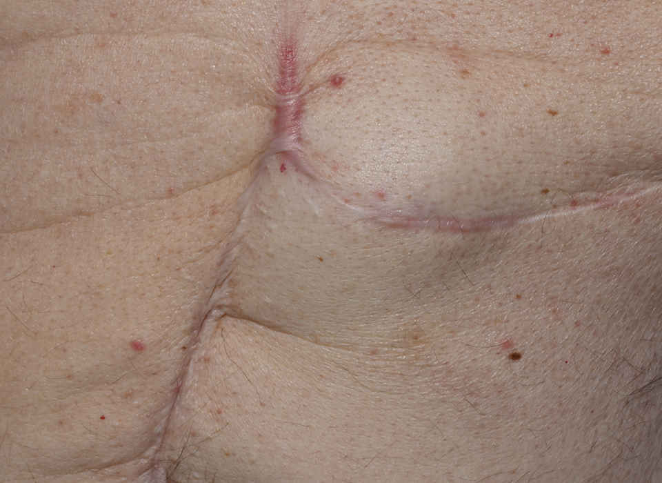 흉터 시그니처 ORACLE Signature