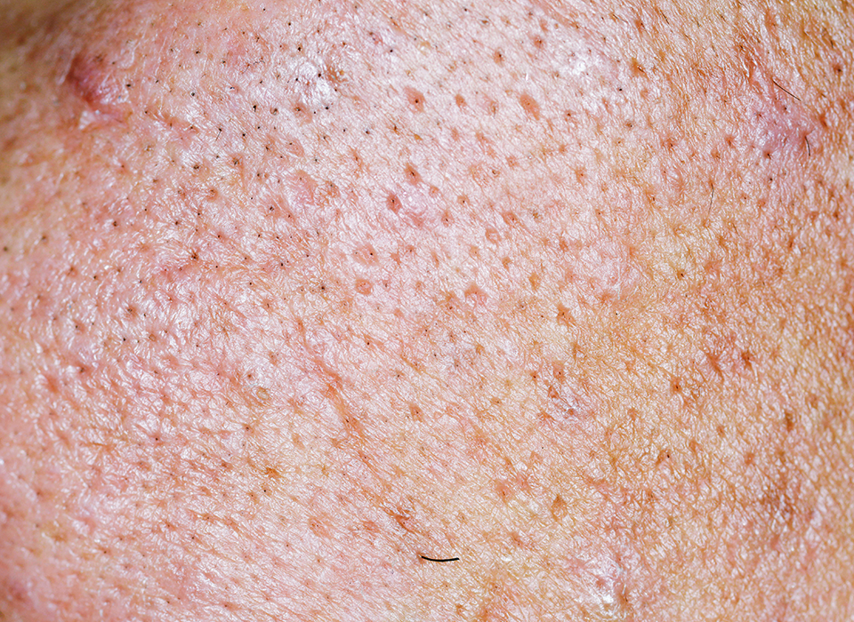 흉터 시그니처 ORACLE Signature