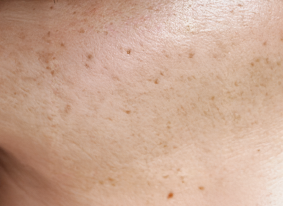 색소 클리닉 ORACLE Revital