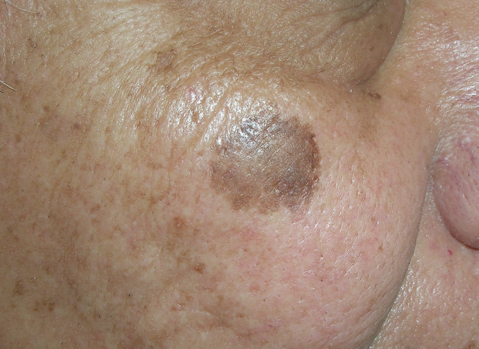 색소 클리닉 ORACLE Revital