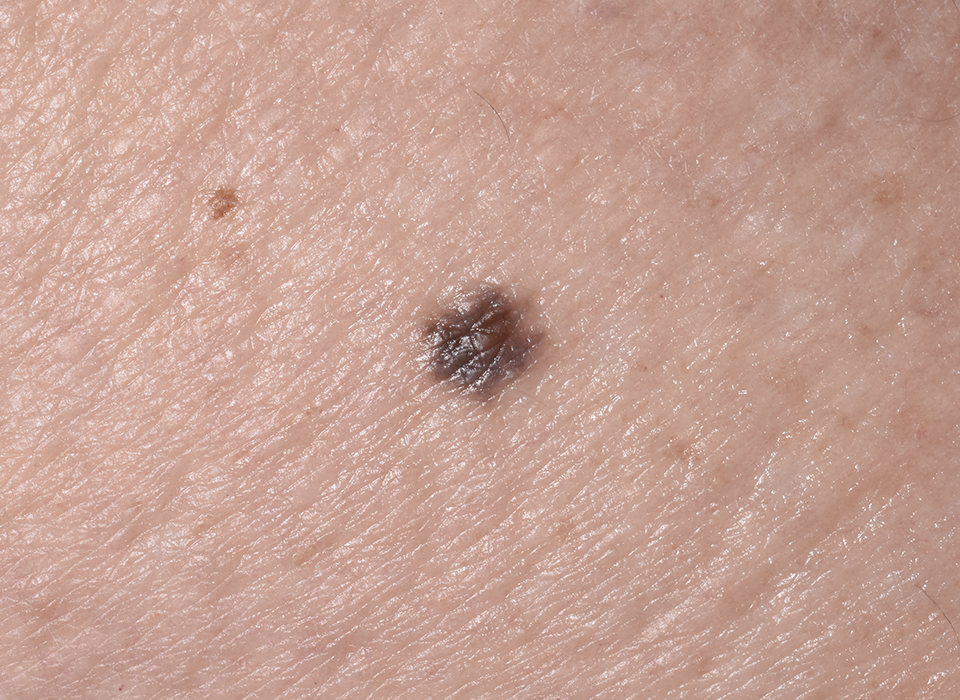 색소 클리닉 ORACLE Revital