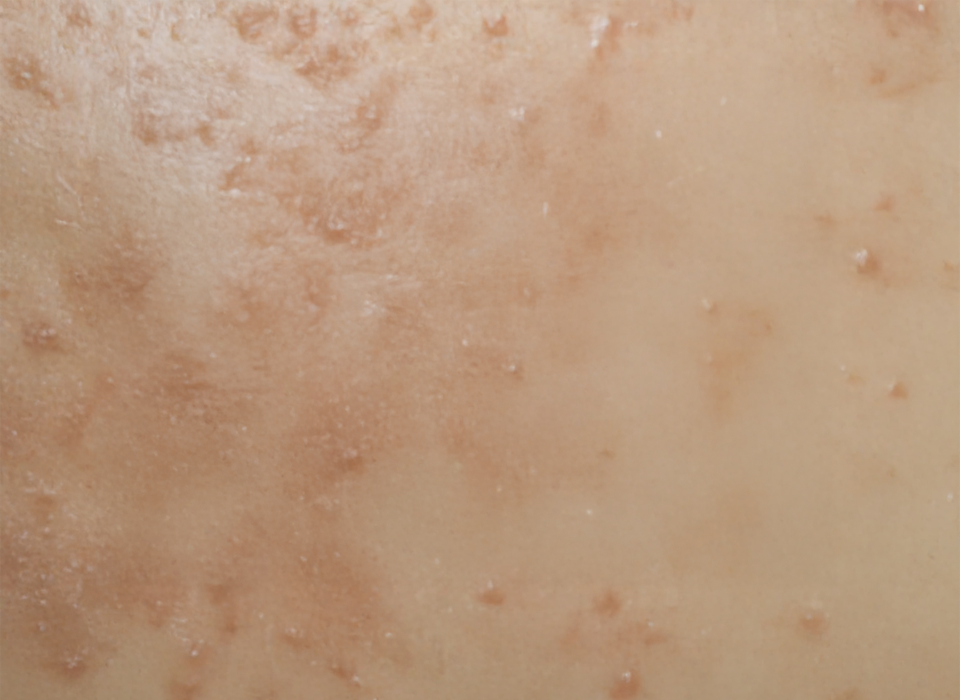 색소 클리닉 ORACLE Revital